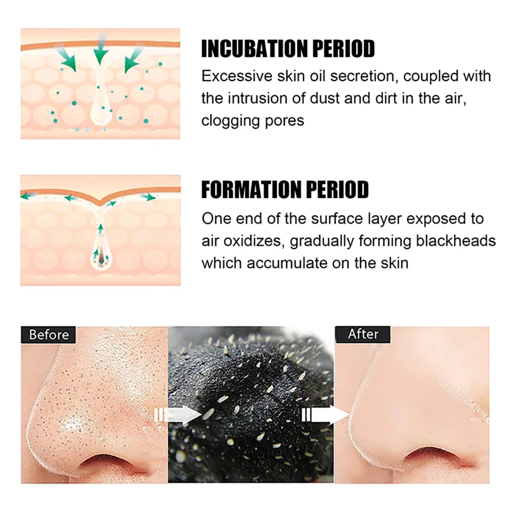 แผ่นลอกสิวเสี้ยนสำหรับทุกเพศ 1 - Charcoal Pore Strip บทวิจารณ์และราคา